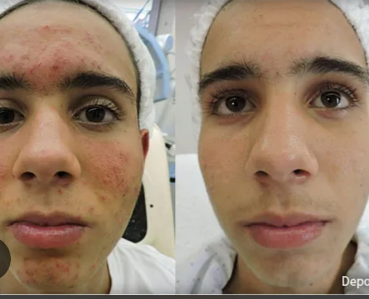 Máscara Facial LED 7 Cores Profissional – Clareia a Pele, Controla Acne e Reduz Poros para Tratamento Facial em Casa