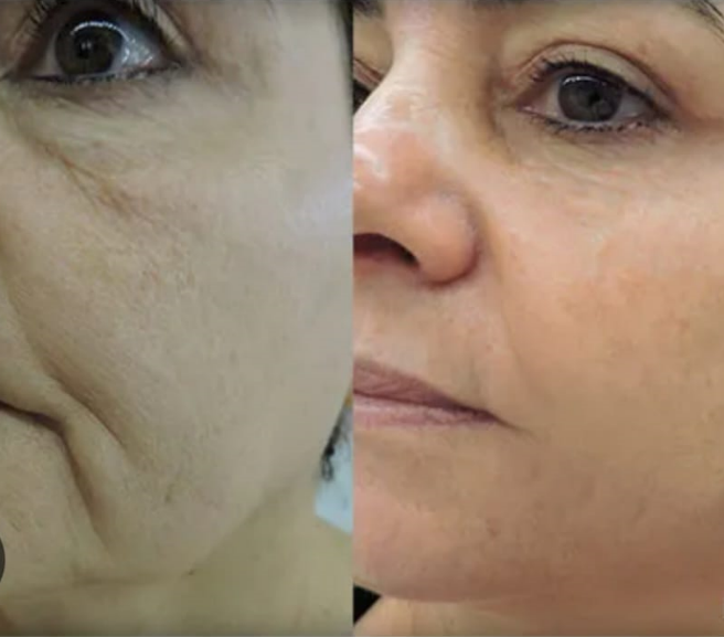 Máscara Facial LED 7 Cores Profissional – Clareia a Pele, Controla Acne e Reduz Poros para Tratamento Facial em Casa