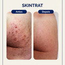 Skintrat 120ml – Solução Antifoliculite e Pelos Encravados